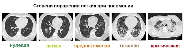 Степени поражения легких при пневмонии