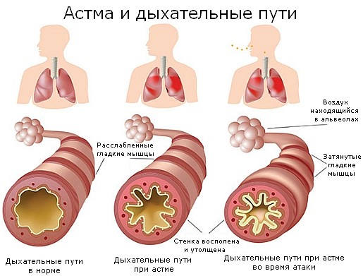 Причины развития бронхиальной астмы и факторы риска